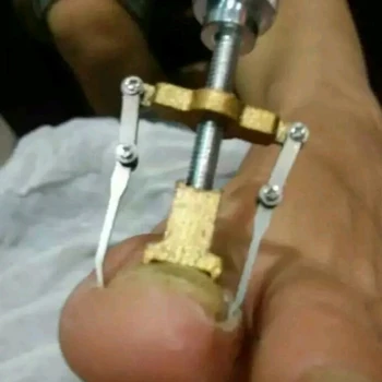 Врастнали нокти на краката Toe Nail Care Tool професионален файл коректор устройство педикюр крака ортопедичен Акроникс Onyxis бурсит на палеца на крака протектор 3062